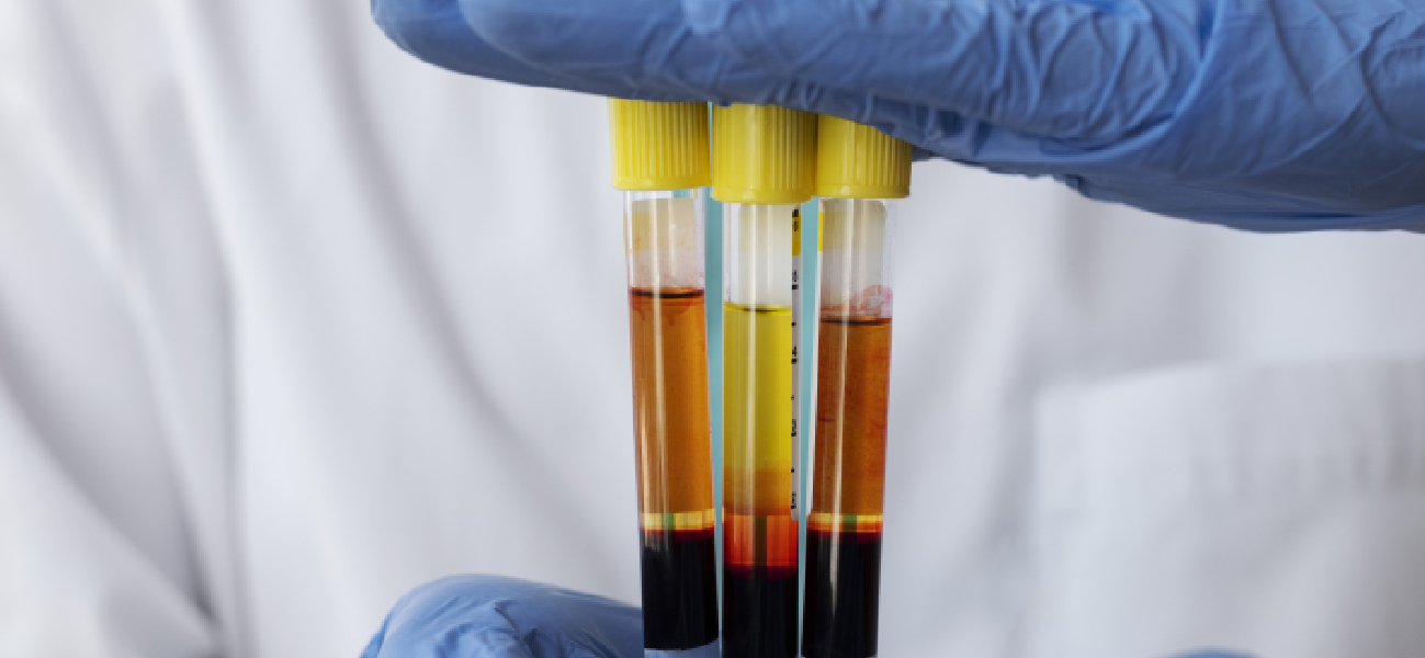 Hematuria 2